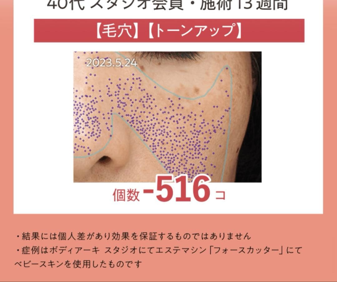 美顔器クリニック級幹細胞湘南美容外科全面監督医療レベル美顔器ベビースキン4回付得