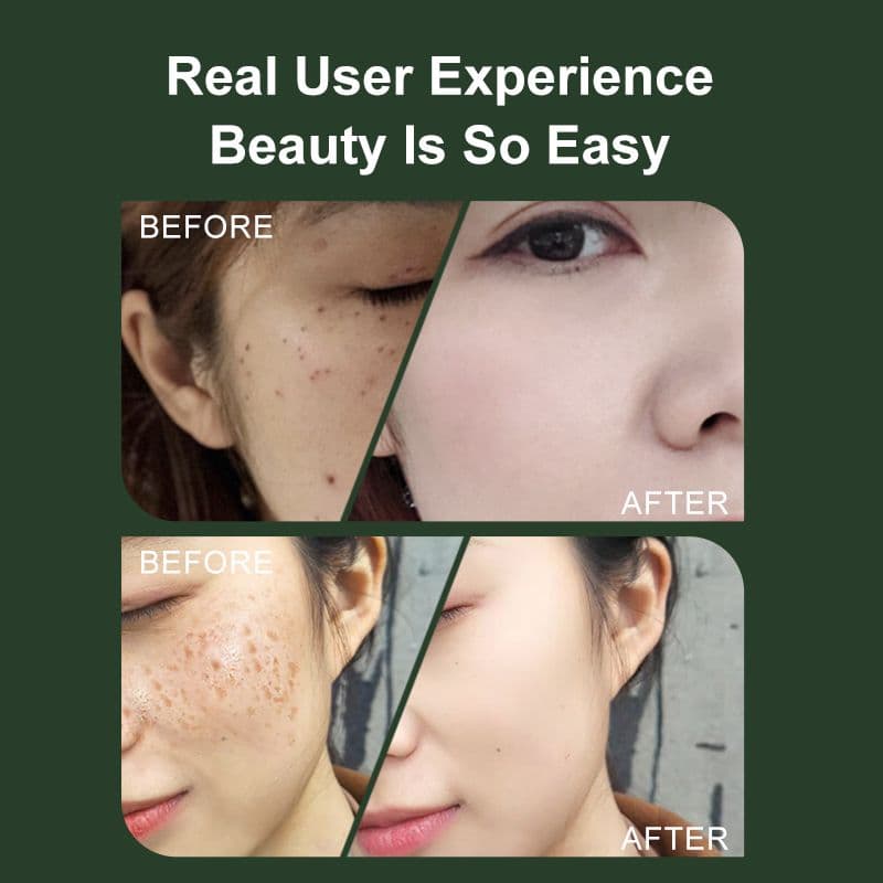 ✨️最安値VLVEE スキンケア機器 ホワイト顔シミ取り✨️