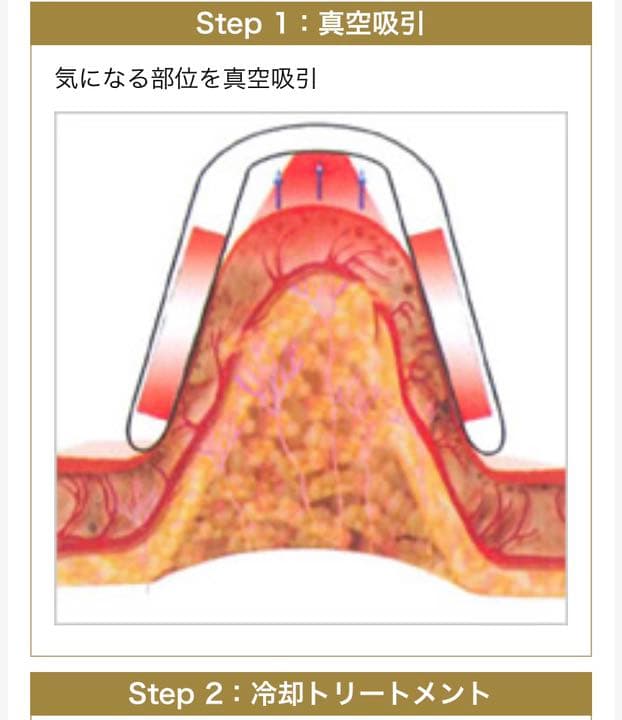 冷凍脂肪溶解 フリーズファット