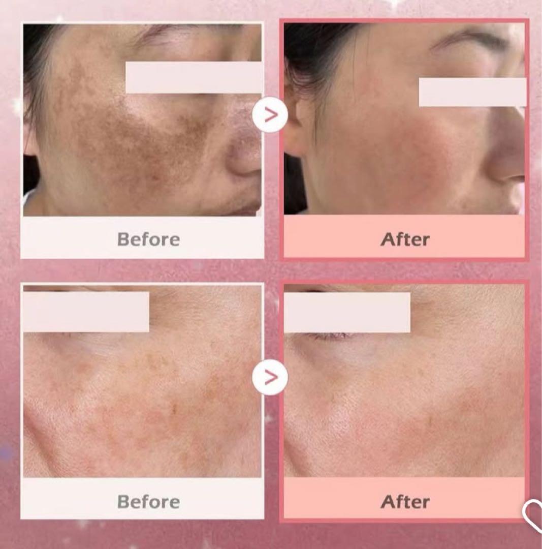 プラズマ plasma 美容　シミ　肝斑　ニキビ　LDM エレクトロポレーション